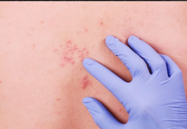 Ministério da Saúde decide não incorporar vacina do herpes zóster ao SUS ministerio-da-saude-decide-nao-incorporar-vacina-do-herpes-zoster-ao-sus