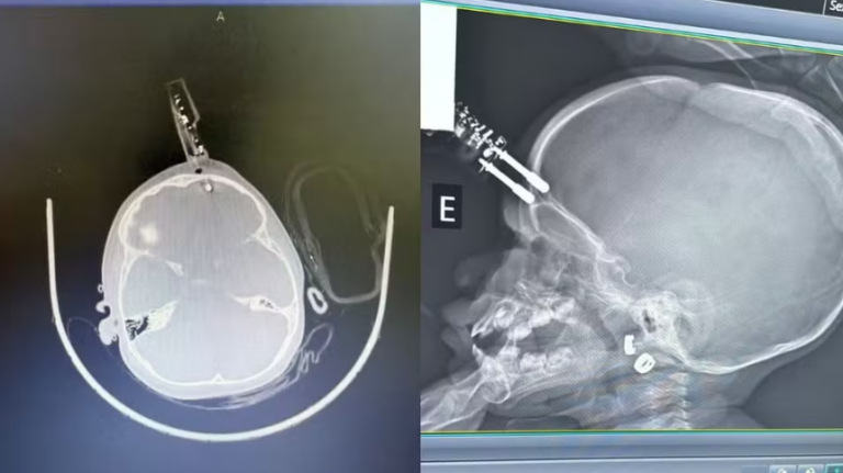 menina-de-1-ano-que-teve-um-carregador-de-celular-cravado-na-testa-ao-cair-da-cama-recebe-alta-medica-apos-cirurgia